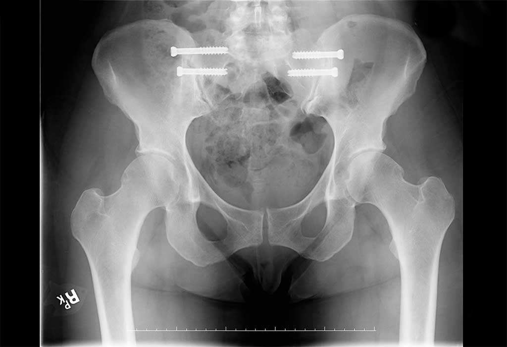 What are some common risks of SI joint fusion surgery?