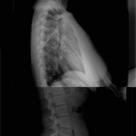 Sideview of Ally's X-rays