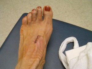 2-week post-op Deep Peroneal Nerve Decompression incision