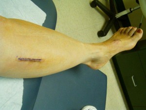 2-week post-op Proximal Tibial Nerve Decompression incision