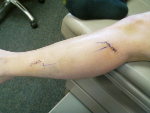 2-week photo post-op nerve decompression before stitches taken out