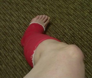 Coban wrapped entire leg support for Proximal & Distal Fibula pain