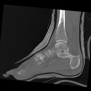 CT Scan 11-5-13,Sagittal Series 8 Image 28