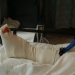 Post HyProCure Surgery-leg splinted with Breg- PolarCare cooling pads under ace wraps
