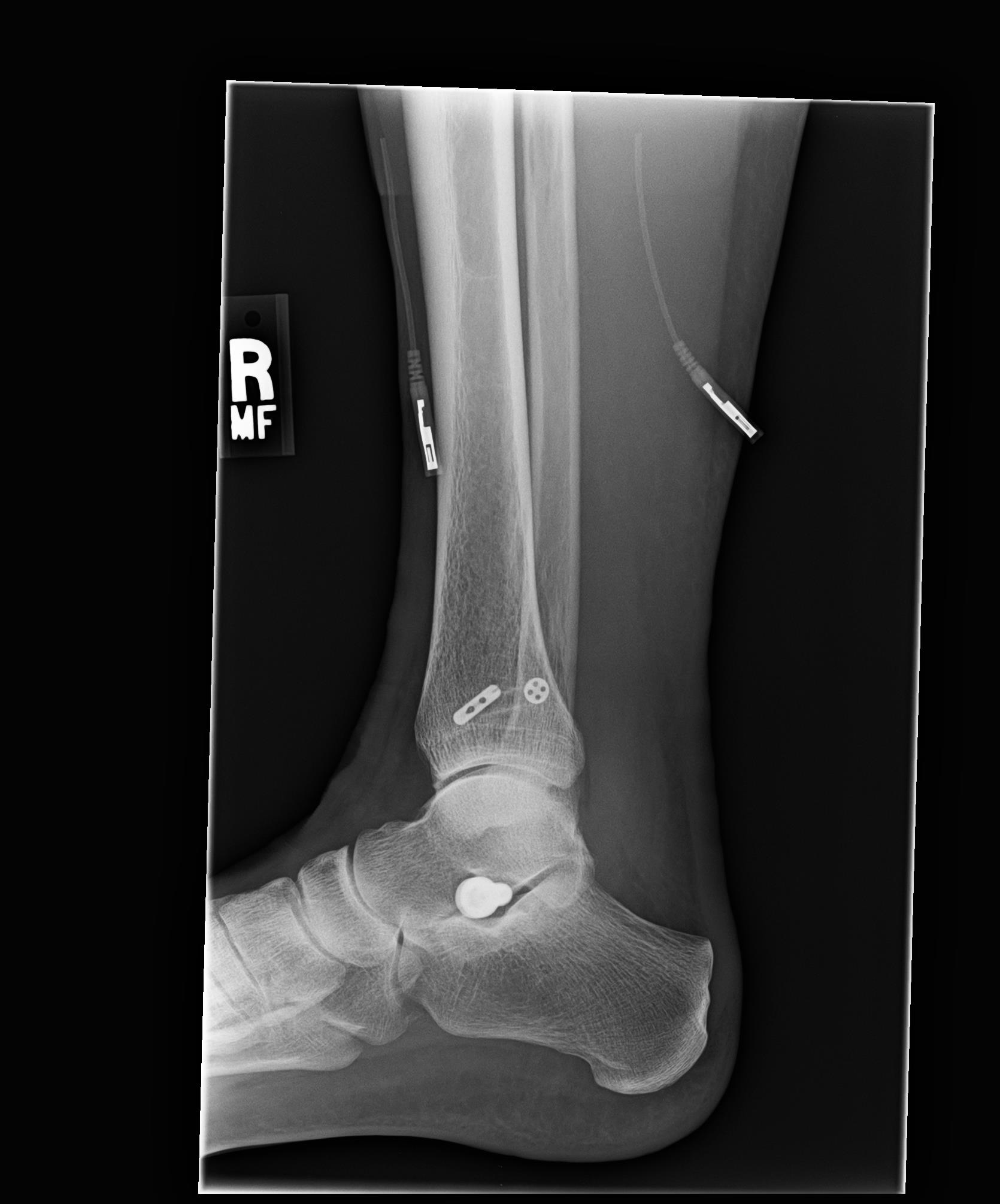 Albums 103+ Images Pictures Of Ankle Replacement Surgery Sharp