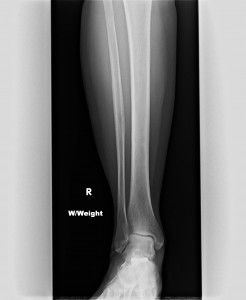 Pre-Surgery Weightbearing Ankle Pronation