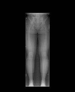 10-28-14 Limb length x-ray study