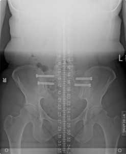 10-28-14 X-ray image as part of a limb length discrepancy x-ray study