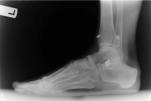 5-14-15 Lateral Left Foot with HyProCure Subtalar Joint Stent