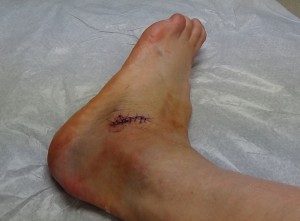 Left Foot 5 days since HyProCure Revision Surgery